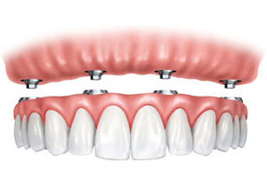 Full mouth Implant Supported Denture