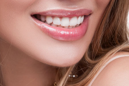 Woman smiling with veneers
