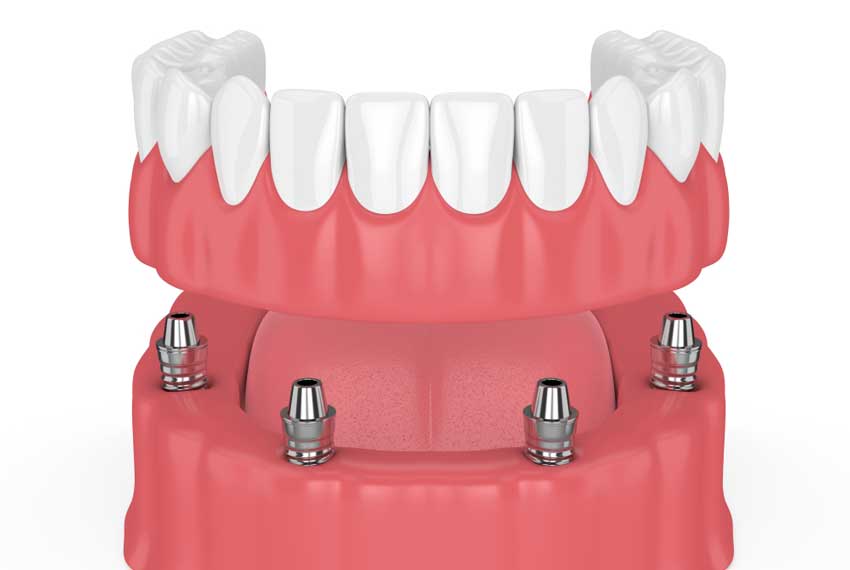 A Fixed or Implant Supported Denture