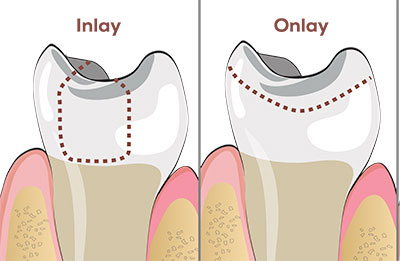 Dental Inlay & Onlay