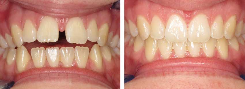 Invisalign Before & After Results